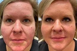 Under Eye Fillers Clinic in Dubai Abu Dhabi