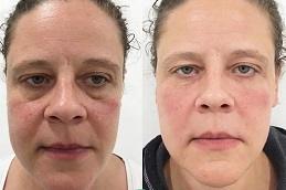 Under Eye Fillers Dubai Abu Dhabi