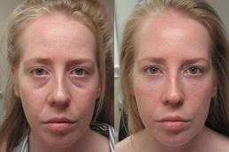 Under Eye Fillers in Dubai UAE