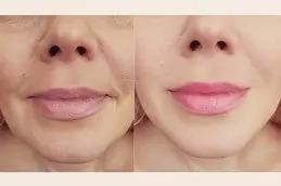 Anti-Aging Treatments in Dubai & Abu Dhabi ,