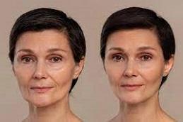 Best American Exosomes before & After Dubai