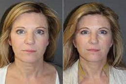 Best American Exosomes before & After clinic Dubai