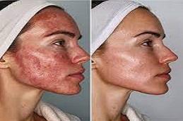 Best American Exosomes before & After in Dubai