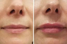 Botox Lip Flip clinic before & after