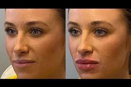 Botox Lip Flip clinic in Dubai