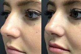 Botox Lip Flip in Dubai 