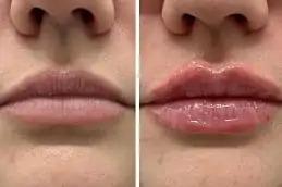 Botox Lip Flip in Dubai & Abu Dhabi,