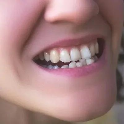 Crooked Teeth Treatment in Dubai Abu Dhabi