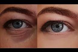 Dark Circles Treatment Dubai & Abu Dhabi