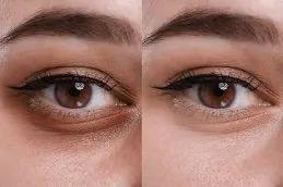 Dark Circles Treatment Dubai & Abu Dhabi
