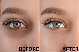 Dark Circles Treatment Dubai