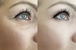 Dark Circles Treatment before & After