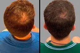 Exosome Hair Treatment before & After
