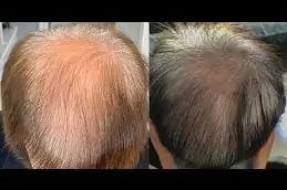 Exosomes Treatment clinic in Dubai