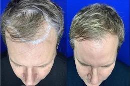 Exosomes Treatment in Dubai & Abu Dhabi