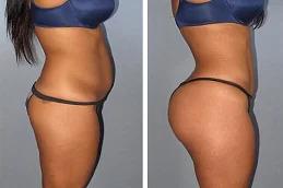 Fat Melting Injections before & After _