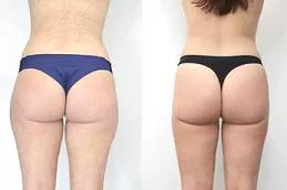 Fat Melting Injections before & After_