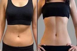 Fat Melting Injections clinic in Dubai