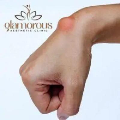 Ganglion Cysts Treatment in Dubai & Abu Dhabi