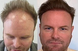Hair Transplant Cost before & After