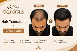 Hair-Transplnat-Before-After-At-Glamrous-Clinic-Islamabad.png