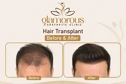 Hair-Transplnat-Before-After-At-Glamrous-Clinic.png