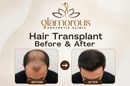 Hair-Transplnat-Before-After-in-Islamabad.png