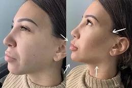 Hyaluronic Acid Injections Abu Dhabi