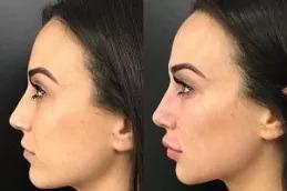 Hyaluronic Acid Injections Dubai