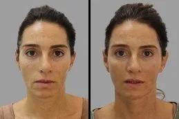 Hyaluronic Acid Injections before & After
