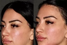 Hyaluronic Acid Injections before & After.