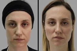 Hyaluronic Acid Injections in Dubai