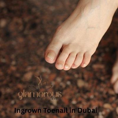 Ingrown Toenail in Dubai