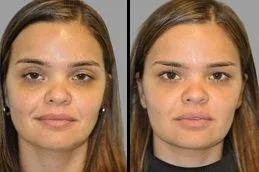 Jawline Fillers Injections Dubai