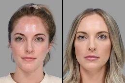 Jawline Fillers Injections before & After