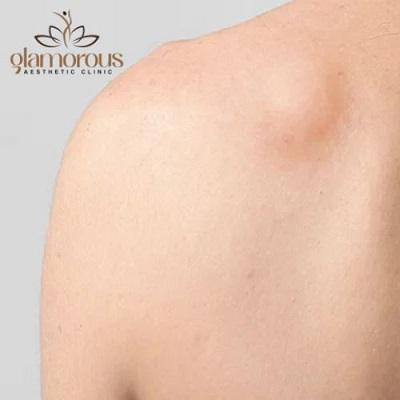 Lipoma Treatment Without Surgery in Dubai