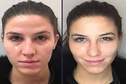 NAD+ IV Therapy before & After.