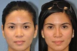 Nose Slimming Injections Dubai & Abu Dhabi