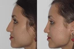 Nose Slimming Injections Dubai