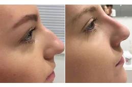Nose Slimming Injections before & After