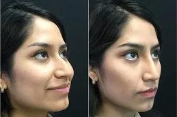 Nose Slimming Injections before& After