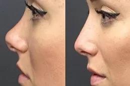 Nose Slimming Injections clinic in Dubai