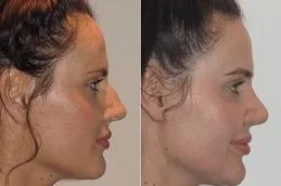 Nose Slimming Injections in Dubai