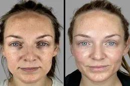 PDRN Salmon DNA Injection befor & After