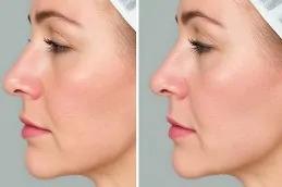 PDRN Salmon DNA Injection in Dubai 