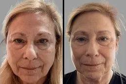 PDRN Salmon DNA Injection in Dubai & Abu Dhabi