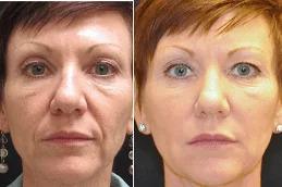 Radiesse Filler Injections & Abu Dhbai