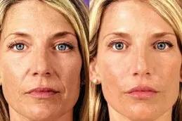 Radiesse Filler Injections Dubai