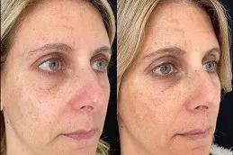 Radiesse Filler Injections before & After
