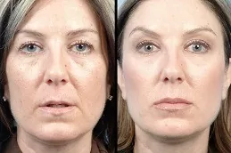 Radiesse Filler Injections before & After.